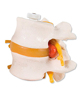 2 Lendenwirbel mit Bandscheibenvorfall, elastisch montiert, 3B Scientific, medishop.de