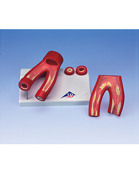 Arteriosklerose Modell, mit Querschnitt der Arterie (2-teilig), 3B Scientific, medishop.de