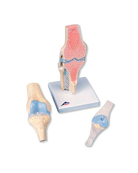 Gelenkschnitt-Modell des Knies, 3-teilig, 3B Scientific, medishop.de