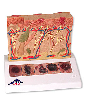 6-Stadien-Hautkrebs-Modell, 3B Scientific, medishop.de