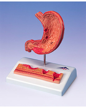 Magen mit Magengeschwren, 3B Scientific, medishop.de