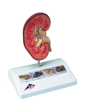 Nierensteinmodell, 3B Scientific, medishop.de