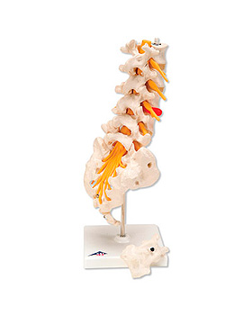 Lendenwirbelsule mit dorsolateralem Bandscheibenvorfall, 3B Scientific, medishop.de