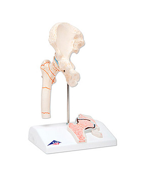 Oberschenkelbruch und Hftgelenk- verschlei, 3B Scientific, medishop.de