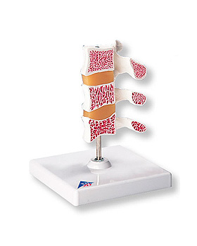 Osteoporose-Luxusmodell (3 Wirbel), 3B Scientific, medishop.de