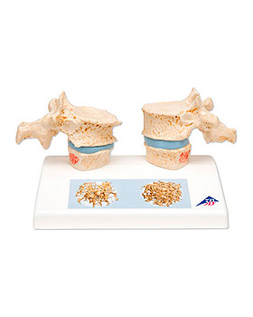 Osteoporose Modell, 3B Scientific, medishop.de
