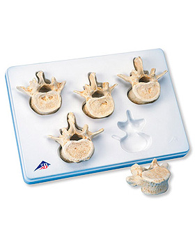 Set mit 5 3B BONElike Lendenwirbeln, 3B Scientific, medishop.de