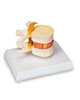 Funktionsmodell fr Bandscheibenvorfall, 3B Scientific, medishop.de