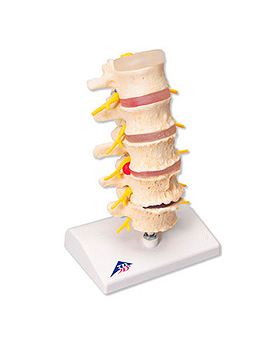 Stadien des Bandscheibenvorfalls und Wirbeldegeneration, 3B Scientific, medishop.de