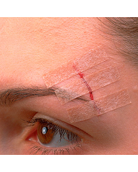 3M Steri-Strip Blendtone 6 x 75 mm, Wundverschlussstreifen (50 x 3 Str.), 3M Medica, medishop.de