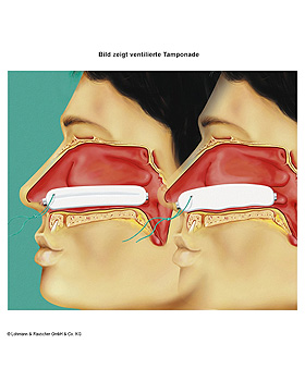 Raucocel Nasentamponaden gerade, ventiliert, mit Faden 80 mm (10 Stck.), Lohmann und Rauscher, medishop.de